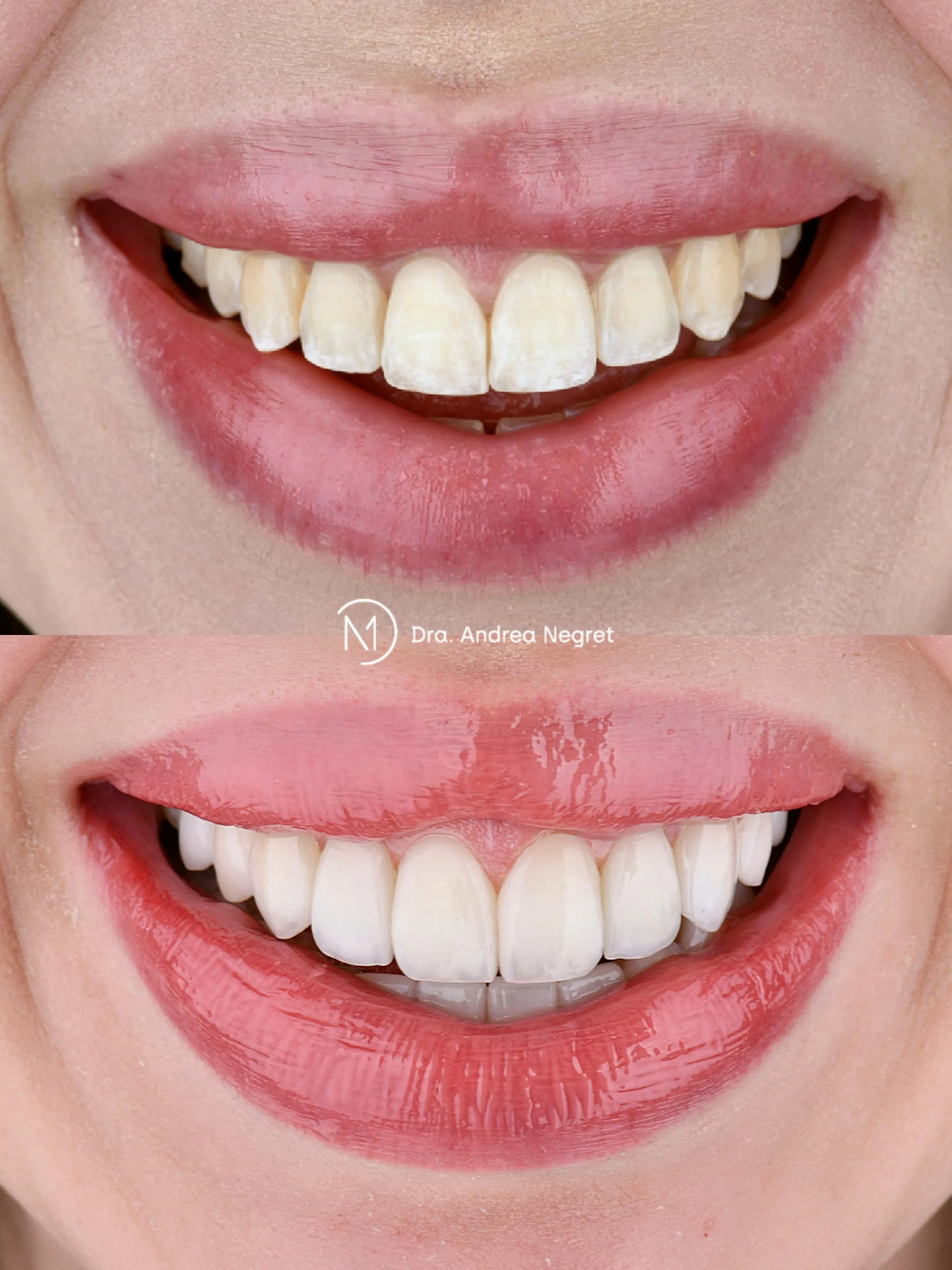 Después de la restauración dental con carillas E-Max premium